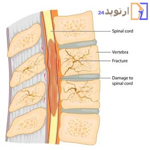 What-is-a-spinal-cord-injury-min