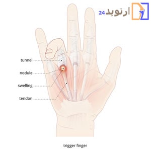 What-is-a-trigger-finger-min