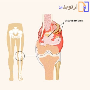 Bone-sarcoma,-treatment-methods-for-sarcoma-in-the-upper-limb-min
