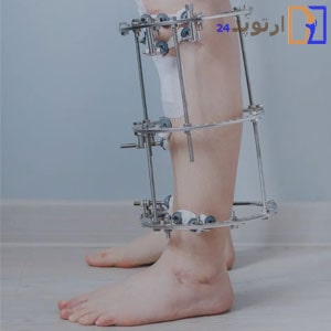 What-is-an-external-fixator-and-how-is-it-used-in-fracture-treatment-min