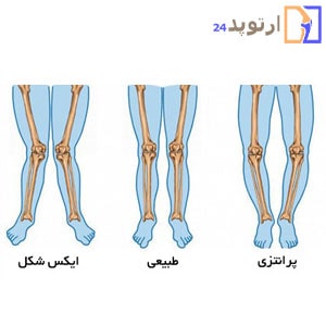 Types-of-surgery-for-clubfoot-advantages-and-disadvantages-min